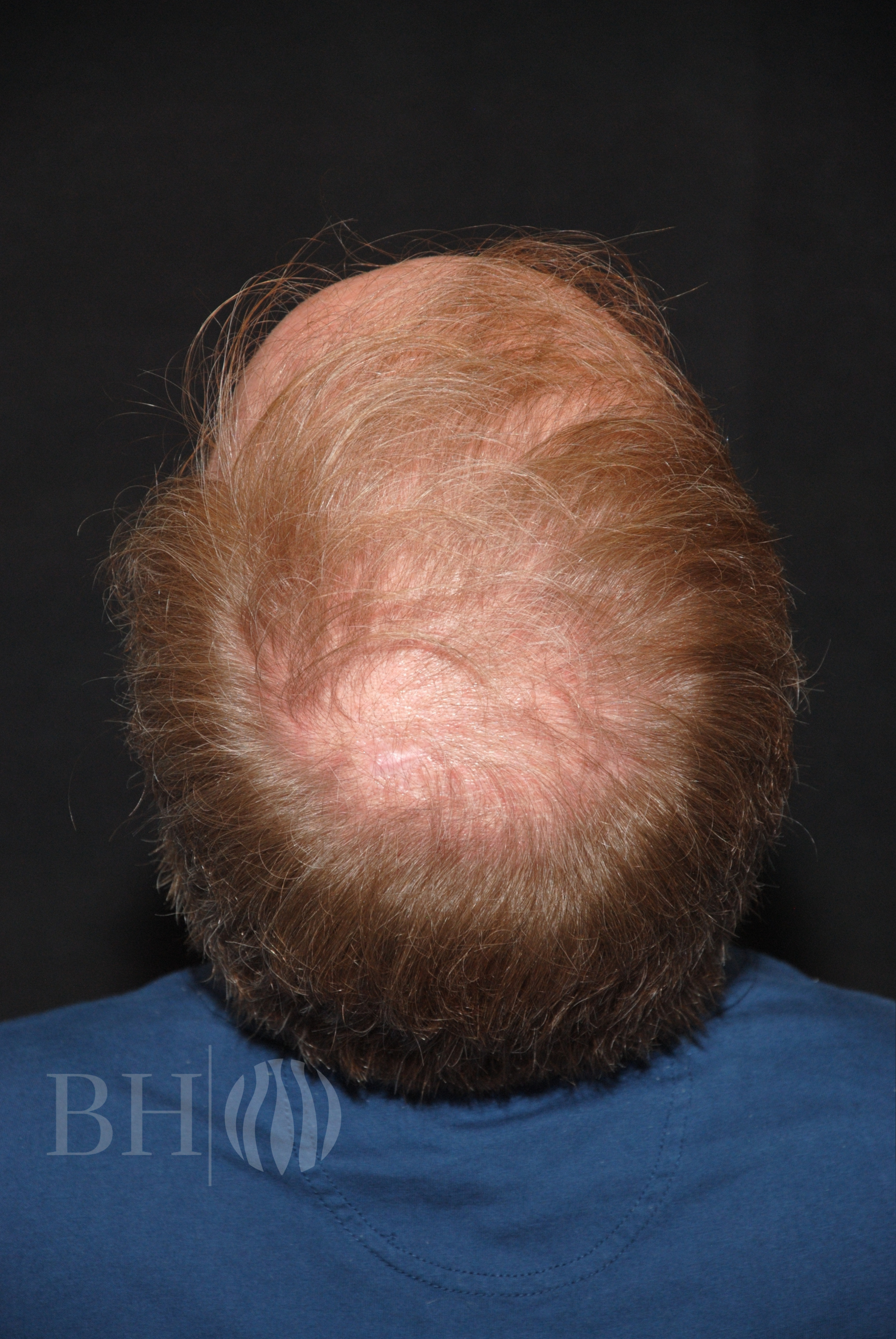 Neograft hair Before and After
